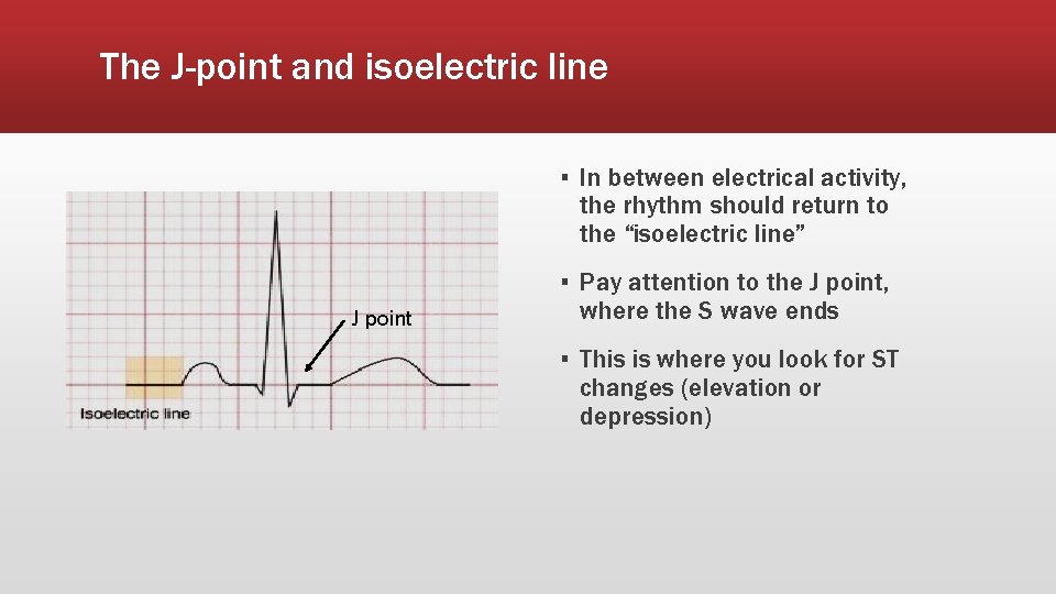The J-point and isoelectric line ▪ In between electrical activity, the rhythm should return