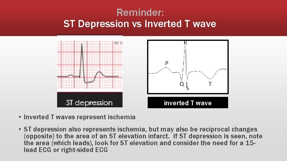 Reminder: ST Depression vs Inverted T wave inverted T wave ▪ Inverted T waves