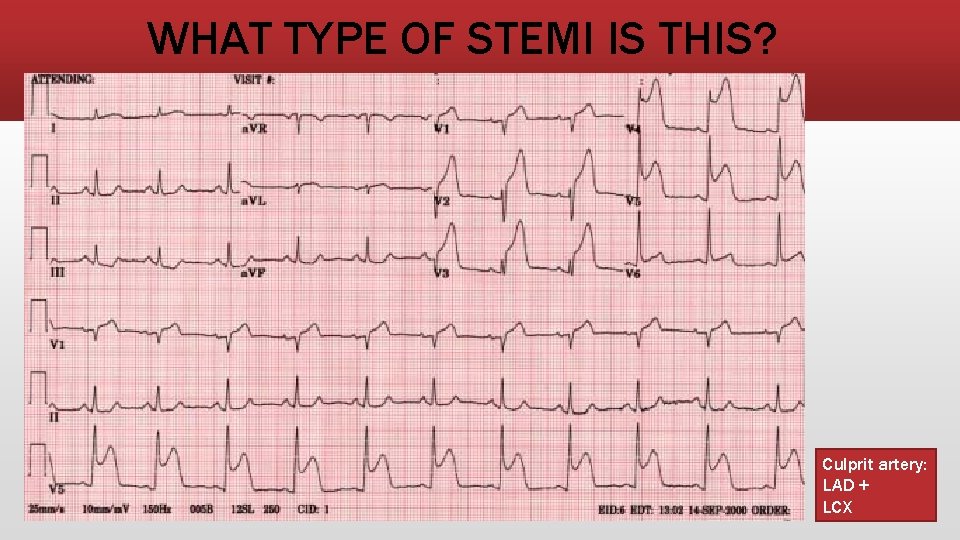 WHAT TYPE OF STEMI IS THIS? Culprit artery: LAD + LCX 