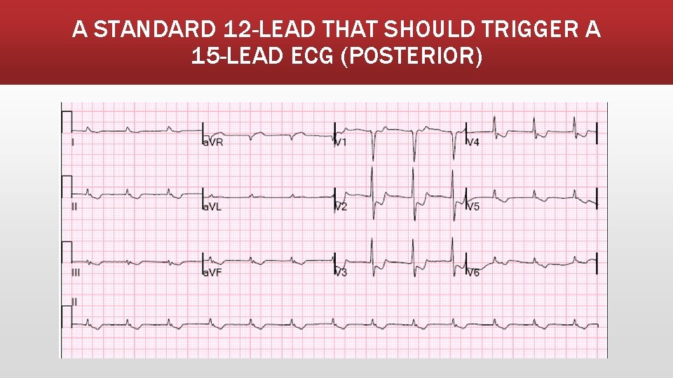 A STANDARD 12 -LEAD THAT SHOULD TRIGGER A 15 -LEAD ECG (POSTERIOR) 