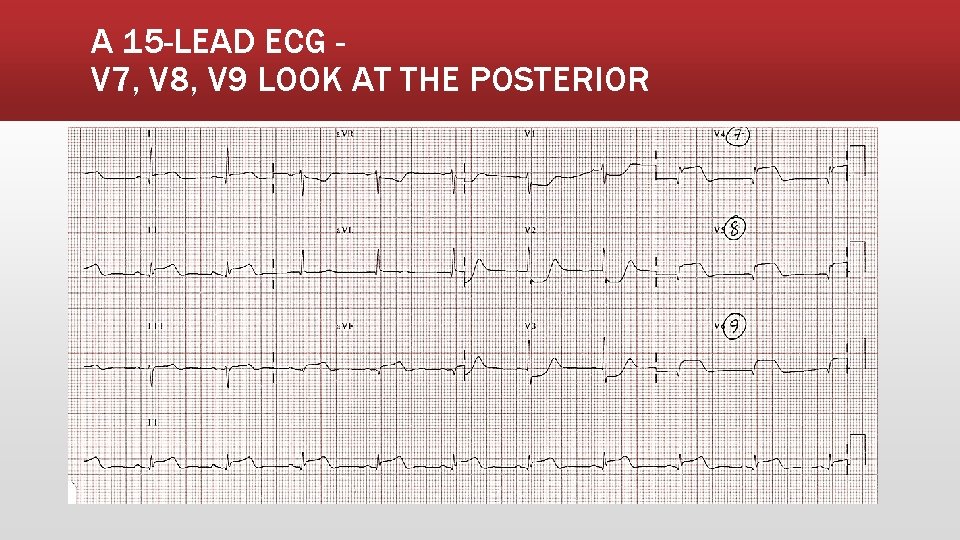 A 15 -LEAD ECG V 7, V 8, V 9 LOOK AT THE POSTERIOR