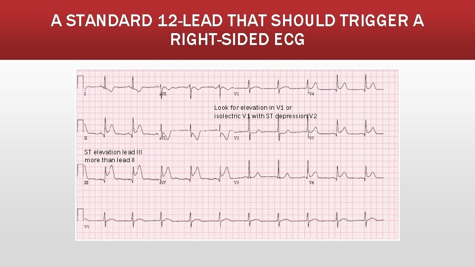 A STANDARD 12 -LEAD THAT SHOULD TRIGGER A RIGHT-SIDED ECG Look for elevation in