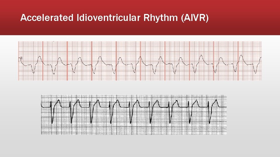 Accelerated Idioventricular Rhythm (AIVR) 