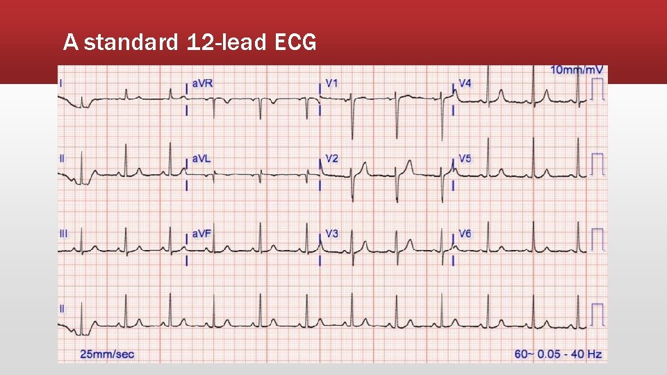 A standard 12 -lead ECG 