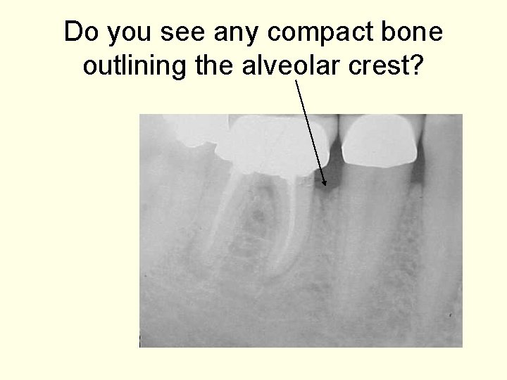 Do you see any compact bone outlining the alveolar crest? 