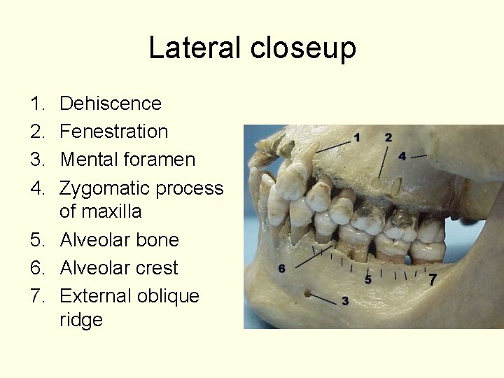Lateral closeup 1. 2. 3. 4. Dehiscence Fenestration Mental foramen Zygomatic process of maxilla