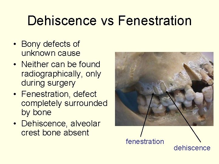 Dehiscence vs Fenestration • Bony defects of unknown cause • Neither can be found