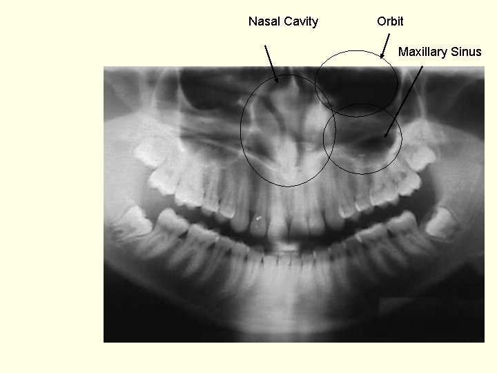 Nasal Cavity Orbit Maxillary Sinus 