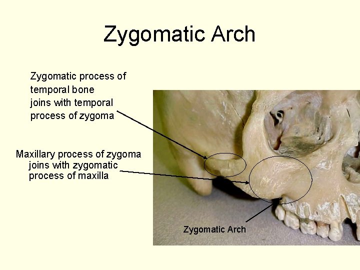 Zygomatic Arch Zygomatic process of temporal bone joins with temporal process of zygoma Maxillary