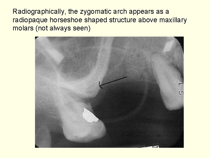 Radiographically, the zygomatic arch appears as a radiopaque horseshoe shaped structure above maxillary molars