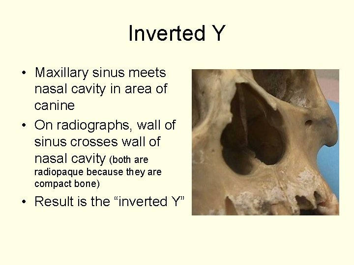 Inverted Y • Maxillary sinus meets nasal cavity in area of canine • On