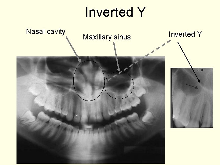 Inverted Y Nasal cavity Maxillary sinus Inverted Y 