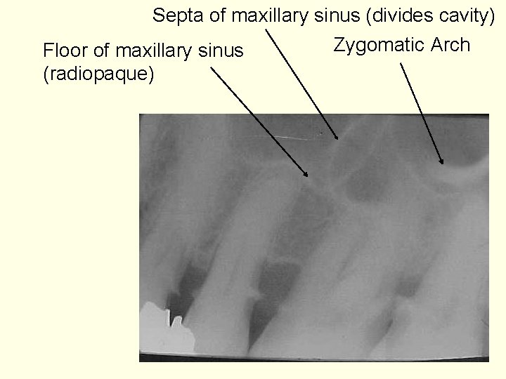 Septa of maxillary sinus (divides cavity) Zygomatic Arch Floor of maxillary sinus (radiopaque) 