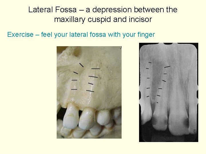 Lateral Fossa – a depression between the maxillary cuspid and incisor Exercise – feel