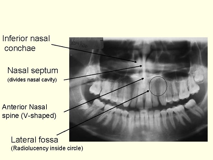 Inferior nasal conchae Nasal septum (divides nasal cavity) Anterior Nasal spine (V-shaped) Lateral fossa