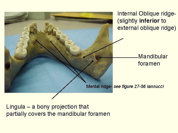 Internal Oblique ridge(slightly inferior to external oblique ridge) Mandibular foramen Mental ridge- see figure