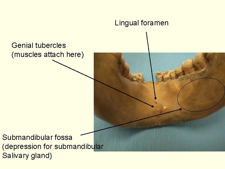 Lingual foramen Genial tubercles (muscles attach here) Submandibular fossa (depression for submandibular Salivary gland)