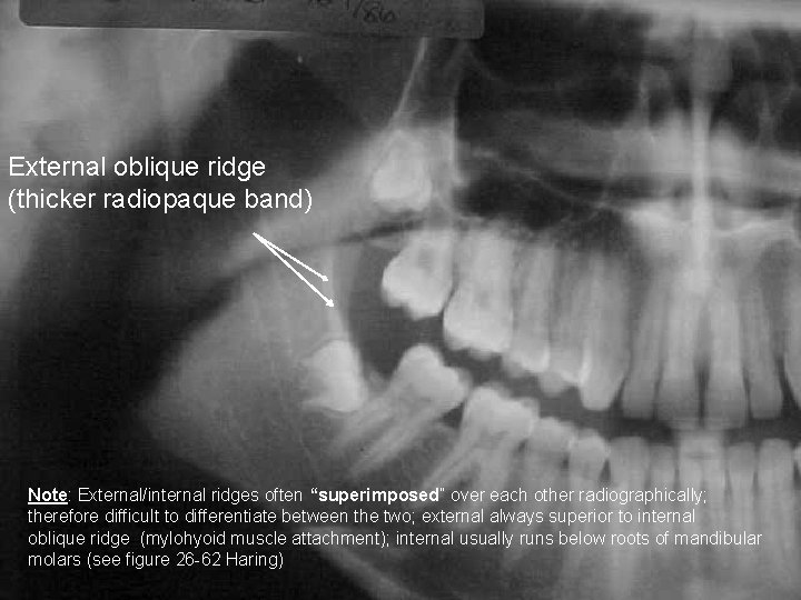 External oblique ridge (thicker radiopaque band) Note: External/internal ridges often “superimposed” over each other