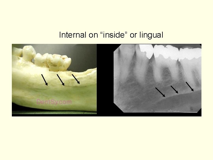 Internal on “inside” or lingual 