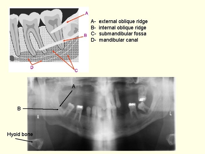 ABCD- A B Hyoid bone external oblique ridge internal oblique ridge submandibular fossa mandibular