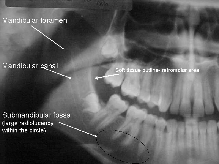 Mandibular foramen Mandibular canal Submandibular fossa (large radiolucency within the circle) Soft tissue outline-
