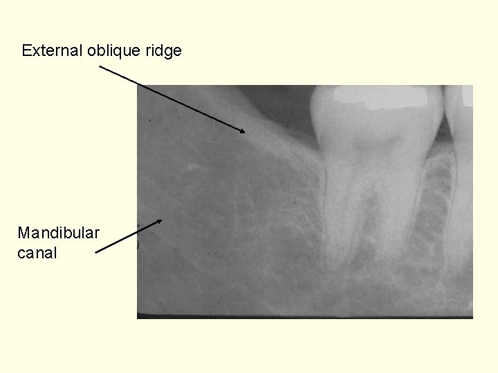 External oblique ridge Mandibular canal 