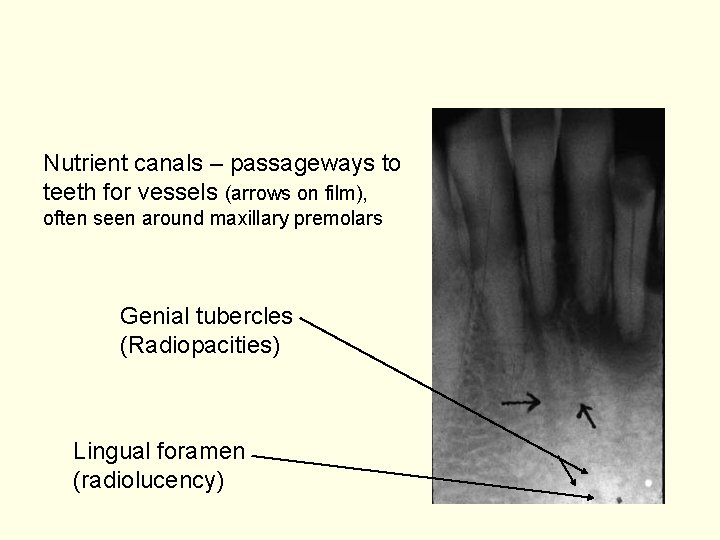 Nutrient canals – passageways to teeth for vessels (arrows on film), often seen around