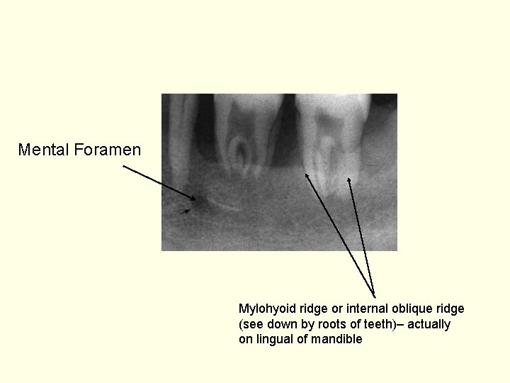 Mental Foramen Mylohyoid ridge or internal oblique ridge (see down by roots of teeth)–