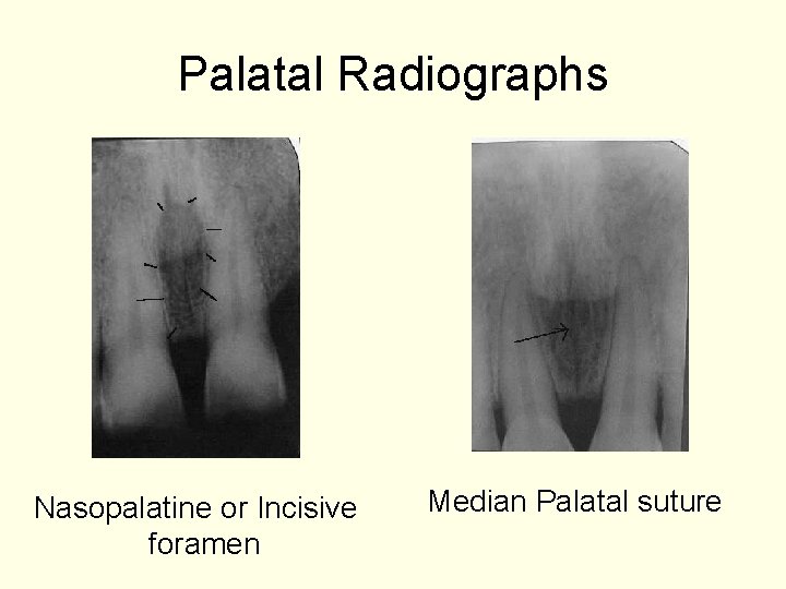 Palatal Radiographs Nasopalatine or Incisive foramen Median Palatal suture 