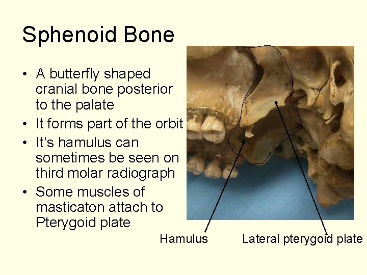 Sphenoid Bone • A butterfly shaped cranial bone posterior to the palate • It