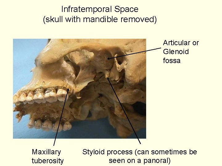 Infratemporal Space (skull with mandible removed) Articular or Glenoid fossa Maxillary tuberosity Styloid process