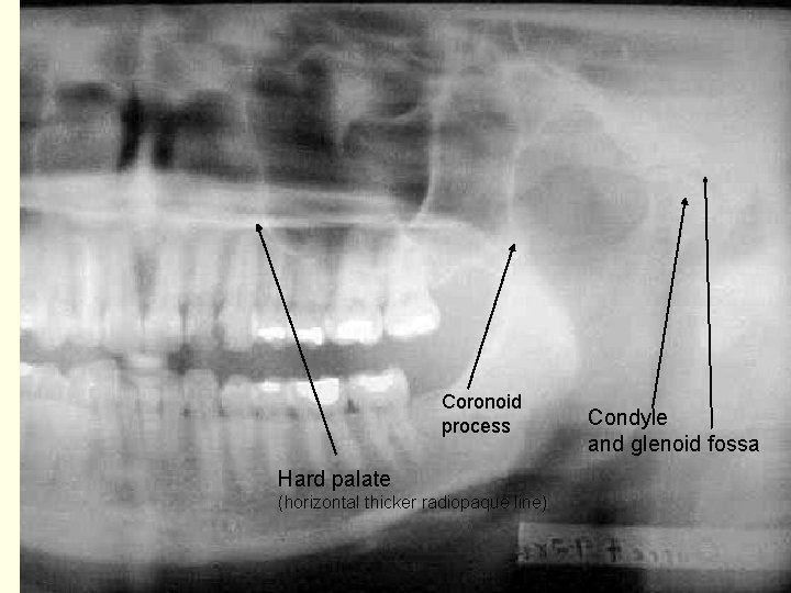 Coronoid process Hard palate (horizontal thicker radiopaque line) Condyle and glenoid fossa 