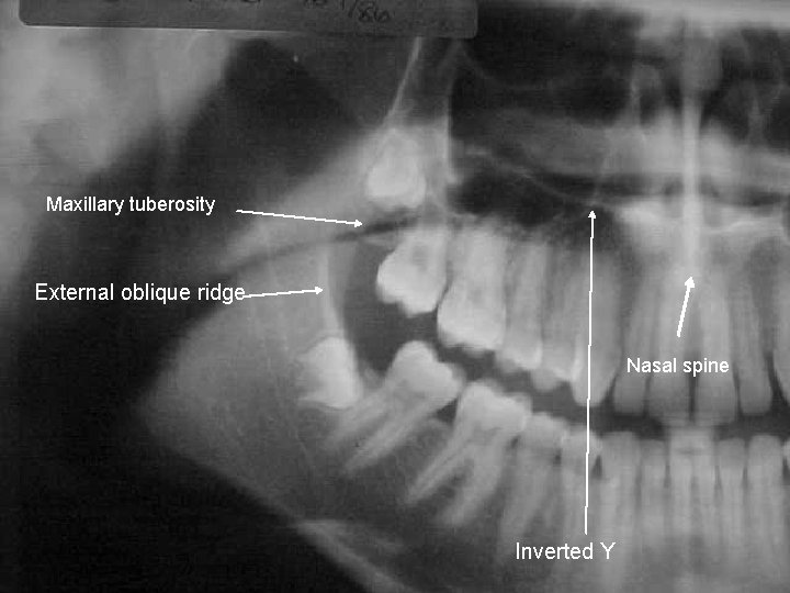 Maxillary tuberosity External oblique ridge Nasal spine Inverted Y 