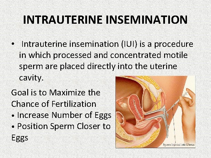 INTRAUTERINE INSEMINATION • Intrauterine insemination (IUI) is a procedure in which processed and concentrated