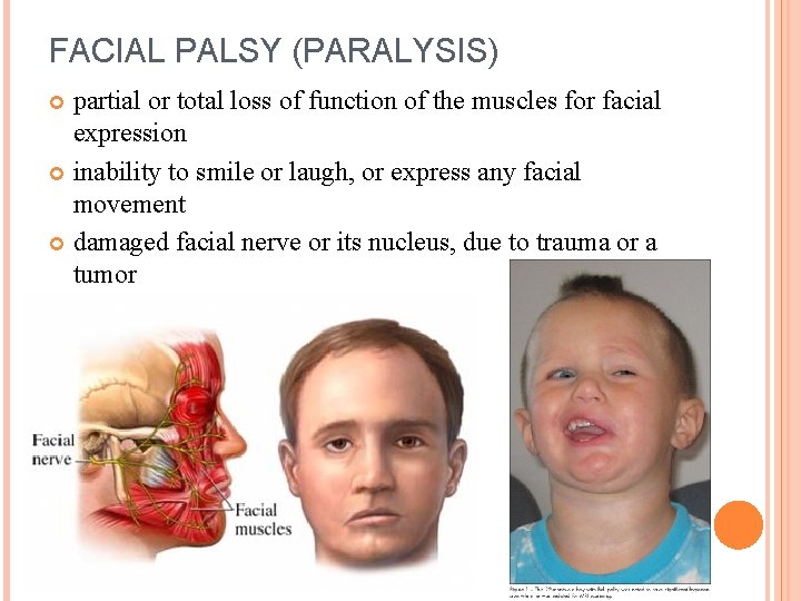 FACIAL PALSY (PARALYSIS) partial or total loss of function of the muscles for facial