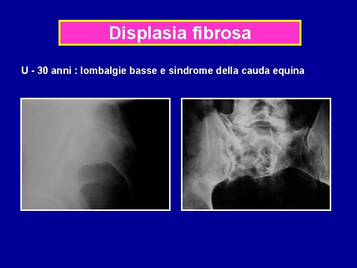 Displasia fibrosa U - 30 anni : lombalgie basse e sindrome della cauda equina