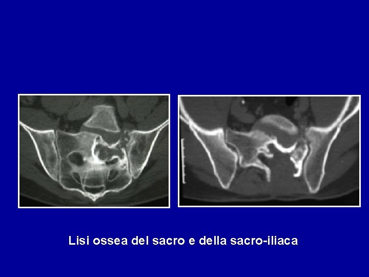 Lisi ossea del sacro e della sacro-iliaca 