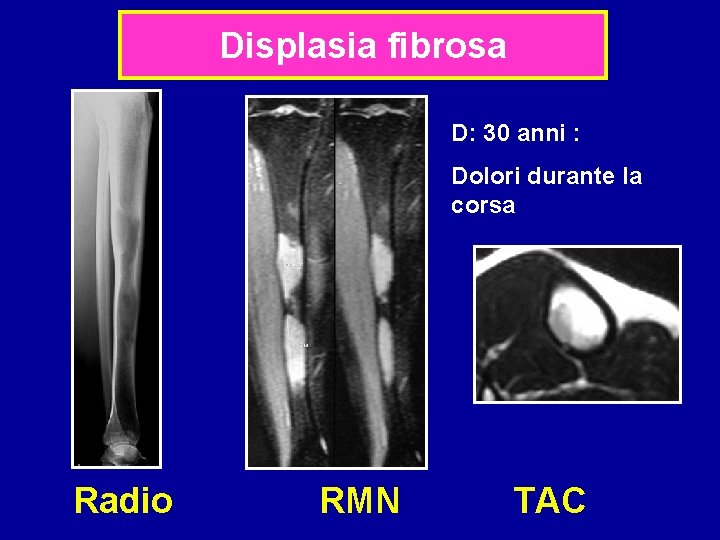 Displasia fibrosa D: 30 anni : Dolori durante la corsa Radio RMN TAC 