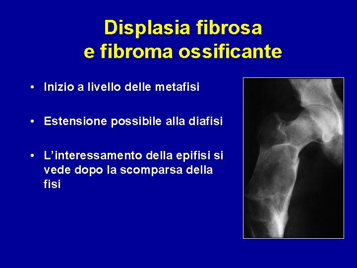 Displasia fibrosa e fibroma ossificante • Inizio a livello delle metafisi • Estensione possibile