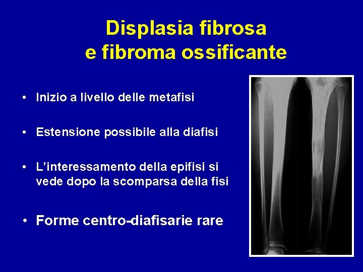 Displasia fibrosa e fibroma ossificante • Inizio a livello delle metafisi • Estensione possibile