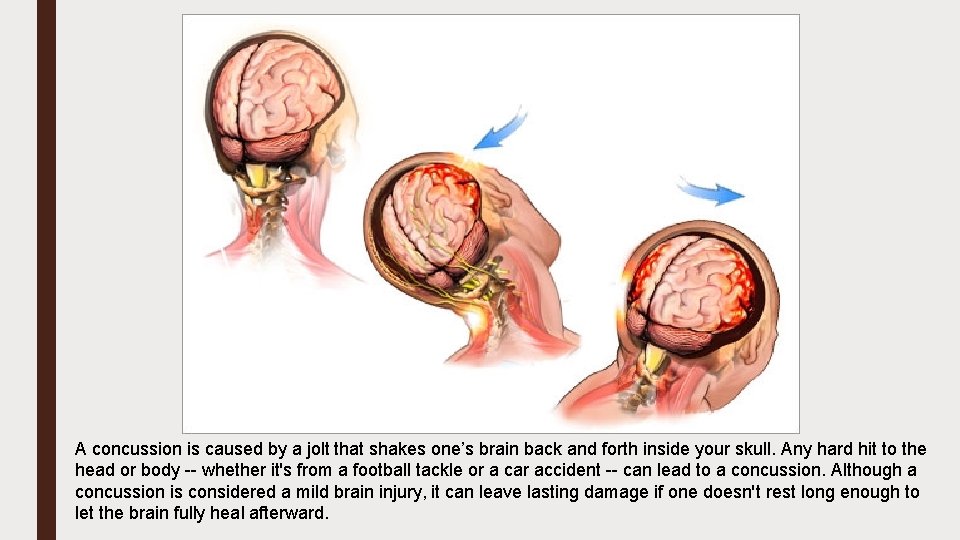 A concussion is caused by a jolt that shakes one’s brain back and forth