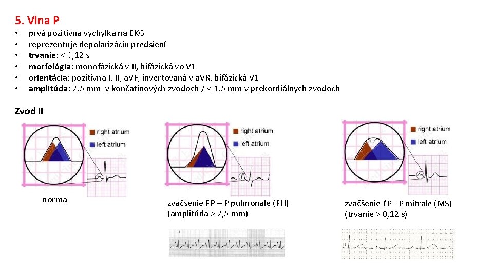 5. Vlna P • • • prvá pozitívna výchylka na EKG reprezentuje depolarizáciu predsiení