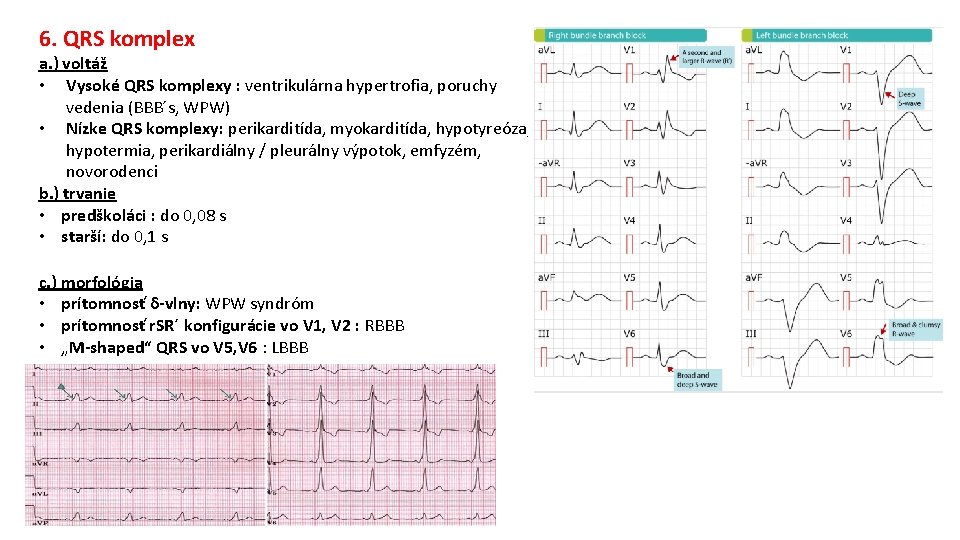 6. QRS komplex a. ) voltáž • Vysoké QRS komplexy : ventrikulárna hypertrofia, poruchy