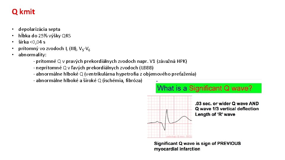 Q kmit • • • depolarizácia septa hĺbka do 25% výšky QRS šírka <0,