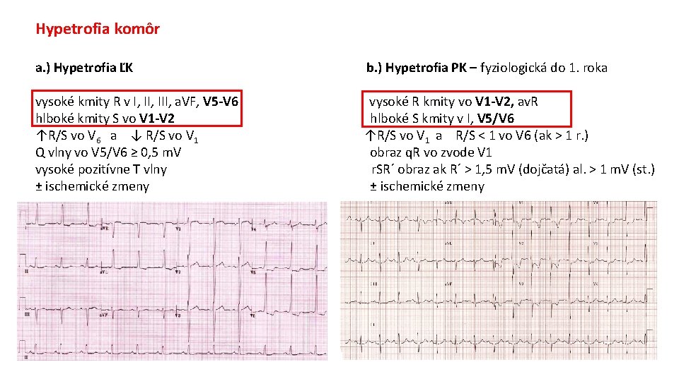 Hypetrofia komôr a. ) Hypetrofia ĽK b. ) Hypetrofia PK – fyziologická do 1.