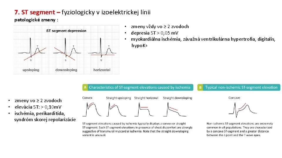 7. ST segment – fyziologicky v izoelektrickej línii patologické zmeny : • zmeny vždy