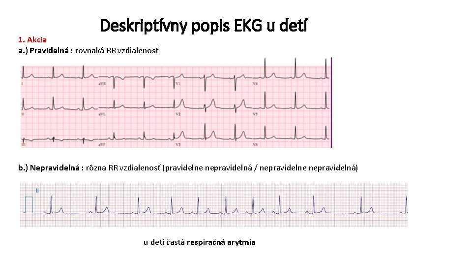 Deskriptívny popis EKG u detí 1. Akcia a. ) Pravidelná : rovnaká RR vzdialenosť