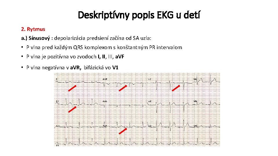 Deskriptívny popis EKG u detí 2. Rytmus a. ) Sínusový : depolarizácia predsiení začína