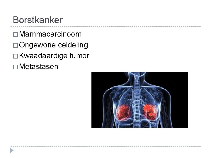 Borstkanker � Mammacarcinoom � Ongewone celdeling � Kwaadaardige tumor � Metastasen 