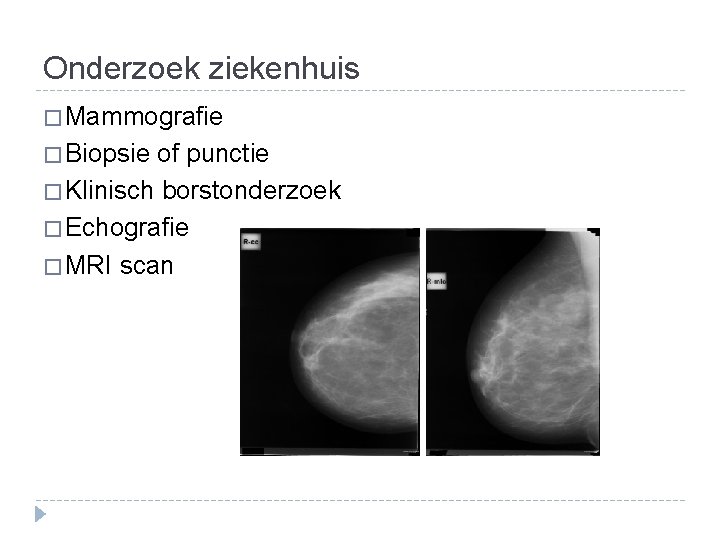 Onderzoek ziekenhuis � Mammografie � Biopsie of punctie � Klinisch borstonderzoek � Echografie �